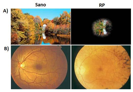 Tesis doctoral Nereida Bravo Gil Figura 6: Síntomas clínicos de RP. A) Pérdida de visión periférica típica de RP (visión de túnel).