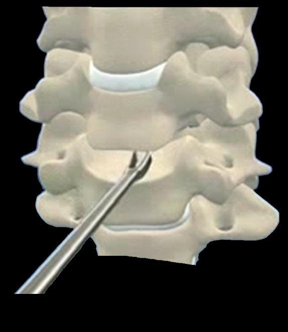 1. Instalación del paciente y abordaje El paciente se instala en posición de decúbito dorsal estricta con la cabeza ligeramente extendida.