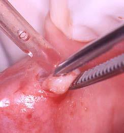 17:-Señale la afirmación verdadera A: La mayoría de las lesiones intraoseas no se relacionan con problemas asociados a la dentición B: No es recomendable realizar la biopsia de todo tejido periapical