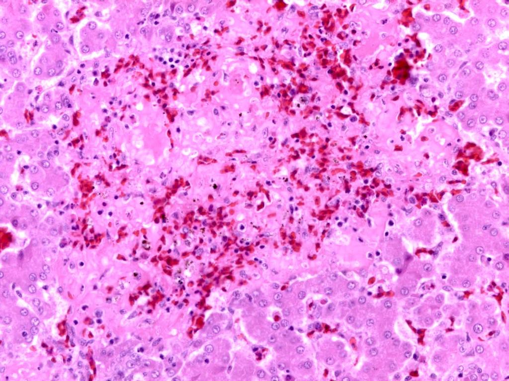 Área de necrosis Hepatitis