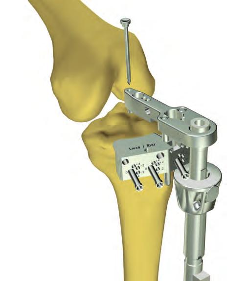 16 Sistema primario de rodilla Innex MIS Técnica quirúrgica Instrucciones quirúrgicas Preparación de la tibia A B Fig. 1 1.