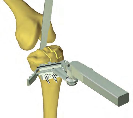 17 Conecte el dispositivo de retención de hojas de sierra al bloque de corte tibial. Reseque la tibia protegiendo al mismo tiempo los ligamentos colaterales (corte 1b, página 15). (Fig.