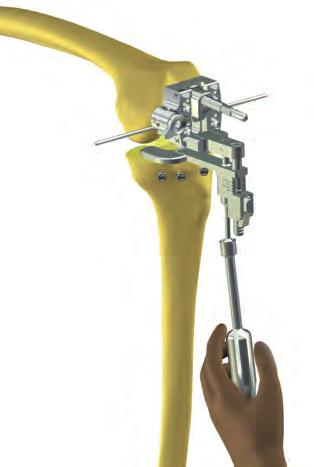 Sistema primario de rodilla Innex MIS Técnica quirúrgica 25 Establecimiento de la rotación femoral y la tensión ligamentosa Introduzca el equilibrador en la guía de corte A/P.
