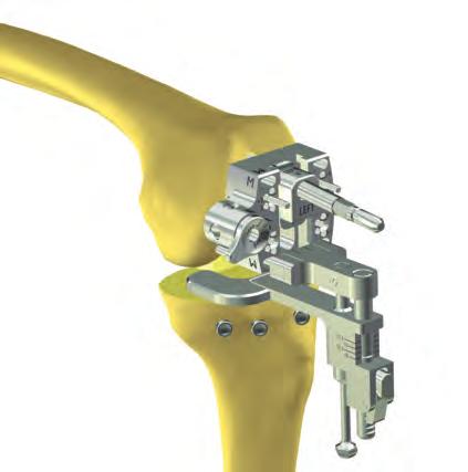 26 Sistema primario de rodilla Innex MIS Técnica quirúrgica Si la tensión ligamentosa es insuficiente, puede extender el equilibrador con el destornillador hasta una altura implantaria más gruesa,