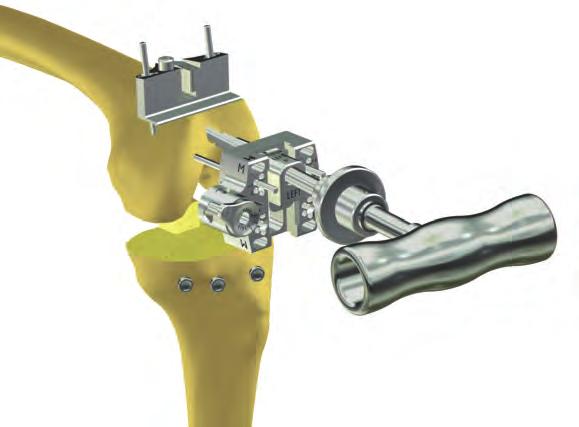 Sistema primario de rodilla Innex MIS Técnica quirúrgica 27 F 3.