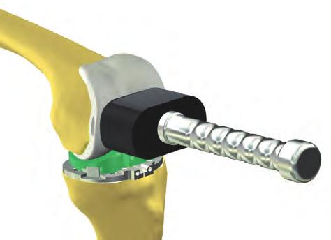 Sistema primario de rodilla Innex MIS Técnica quirúrgica 35 Monte el componente femoral de prueba del tamaño pertinente sobre el fémur utilizando la