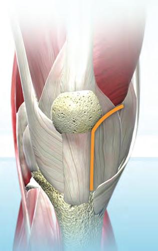 transversal de los tendones y músculos del aparato extensor y la cápsula articular, así como el grado de resección ósea y manipulación de la rótula.