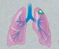 La cirugía puede llevarse a cabo por otras afecciones también, por ejemplo, en el caso del colapso de un pulmón o si detecta la presencia de líquido en torno al pulmón.