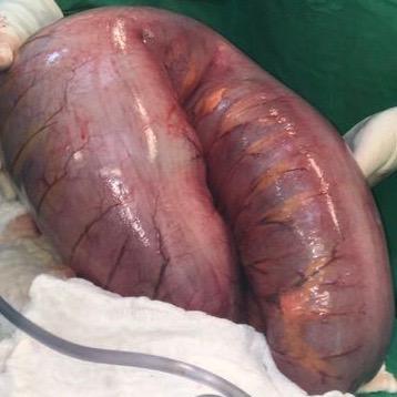 Manual de enfermedades digestivas quirúrgicas En EEUU es la tercera causa de obstrucción intestinal, luego de el cáncer colorrectal y la enfermedad diverticular del colon (12).