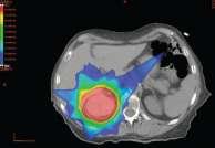 SBRT carcinoma células renales Incidencia incrementada por el amplio uso de CT y ECO abdominal diagnosticando tumores asintomáticos Cirugía tratamiento estándar en paciente operable Leyenda de ser