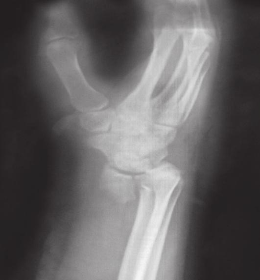 Figura 19. Caso 1. RX lateral posoperatoria inmediata.