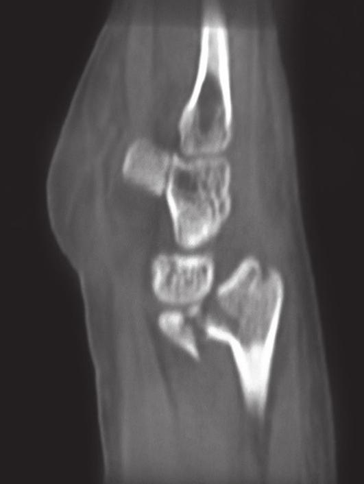 Figura 20. Caso 2. Radiografía Lateral preoperatoria de muñeca izquierda.