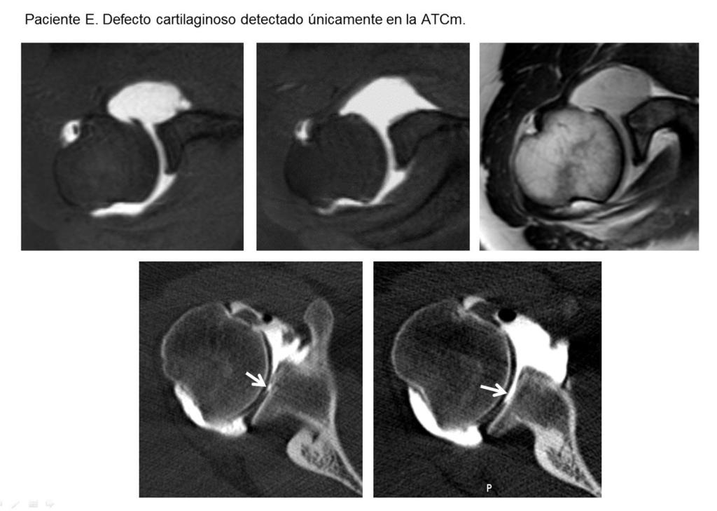 Fig. 12: Cortes axiales de la adquisición de ATCm que muestran paso de contraste articular hasta la cortical de la glena; defecto