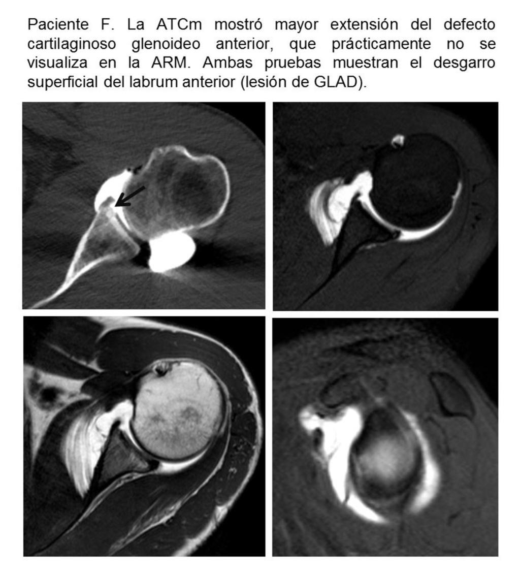 Fig. 13: Secuencias T1 SE i T1 SP axiales de ARM i corte axial de ATCm que muestran un desgarro superficial del labrum anterior con lesión cartilaginosa (grado