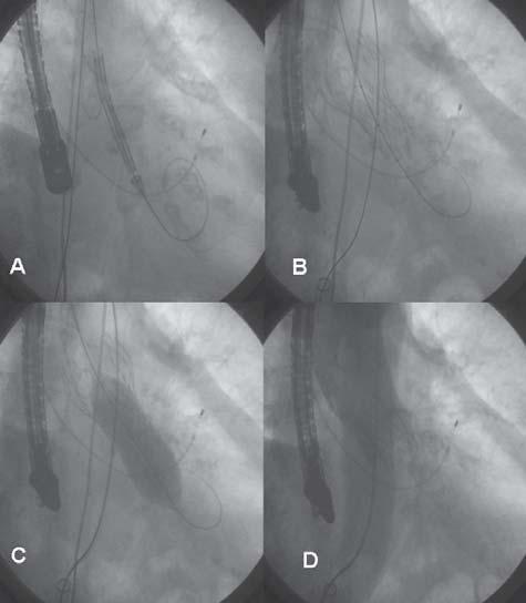 ETT: Ecocardiograma transtorácico. AI: Aurícula izquierda. TSVI: Tracto de salida del VI. VI: Ventrículo izquierdo. Ao: Aorta ascendente. Fig. 2. A. Medición del calibre de las arterias femoral e ilíaca mediante angiografía cuantitativa.