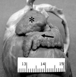 234 LA González Ramos y cols. Fig. 3. A: Aorta (Ao) emerge del infundíbulo de ventrículo derecho ( ). B: Arteria pulmonar (ap) emerge de ventrículo izquierdo (VI). Inf. Sub Ao: infundíbulo subaórtico.