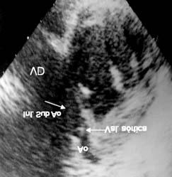 Al delimitar ésta, se notó un área de ventrículo derecho de menor tamaño en relación al área ventricular izquierda; la arteria pulmonar estaba dilatada y con una emergencia posterior a la aorta.