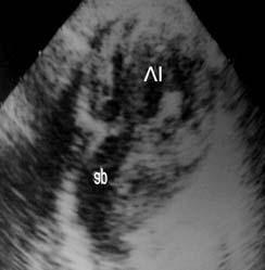 Ap: Arteria pulmonar. Ao: Aorta. VD: Ventrículo derecho. VI: Ventrículo izquierdo. digital y diurético.