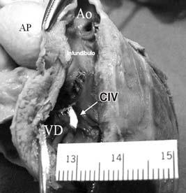 En proyección lateral, se apreció mejor la orejuela de morfología derecha superior (*) así como la orejuela de morfología izquierda inferior ( ) (Fig. 5).