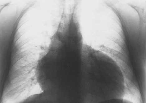 Indicaciones del trasplante CP Neumopatía terminal con cor pulmonale irreversible Cardiopatía terminal