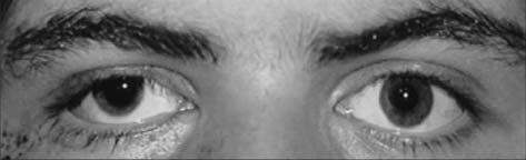 19 Acta Estrabológica Figura 28. El paciente presenta ptosis y midriasis del ojo derecho por lesion del III nervio traumática.