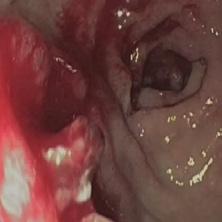 Gastritis Desgarros de Mallory-Weiss Esofagitis Neoplasias