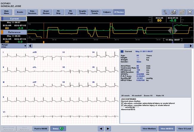 La revisión de ST puede utilizarse para detectar cambios sutiles en el segmento ST y revisar las tendencias (actual con respecto a la de referencia) en monitorización cardiaca e intentos de retirar