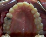 Exodoncia de 3.4 / 3.5 me- 39. sio-gresión de todo el sector molar. Del 3.