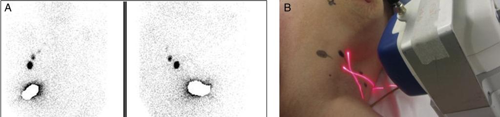 Figura Nº 02. Localización intraoperatoria del ganglio centinela con la gammacámara portátil.