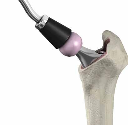 PASO 7 REDUCCIÓN FINAL PASO OPCIONAL Al seleccionar una cabeza femoral de cerámica de cono universal BIOLOX delta (6519-1-0xx) para el implante, es necesario utilizar un manguito adaptador universal.