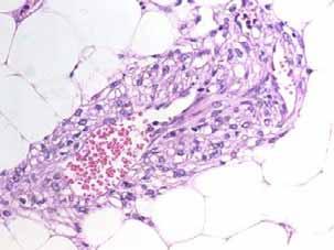 PEComa OMS (2002): tumor mesenquimal compuesto por células epitelioides perivasculares (PECs) identificadas por histología e inmunohistoquímica PEC:Apitz 1943 abnormal myoblast Angiomiolipoma renal