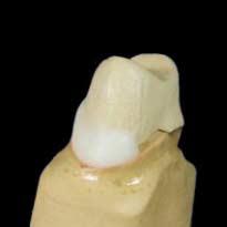 10 Indicaciones de uso La técnica de masas de hombro Restauración protésica: Protésico Dental Jürgen Braunwarth 5 6 7 8 Durante el desarrollo de la cerámica Kiss se ha puesto especial énfasis en la
