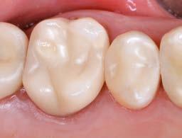 Las restauraciones no solo se integran de forma visualmente armoniosa en la estética global, sino que tampoco se diferencian hápticamente de la sustancia dental natural.