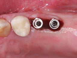 2. Digitalización y diseño En primer lugar se expusieron los implantes y se fijaron sobre ellos postes de escaneo y cuerpos de escaneo compatibles (Sirona Dental) (figs. 3 y 4).