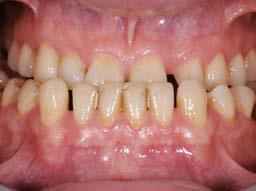 Además, las propiedades del material debían asemejarse en la mayor medida posible a las del diente natural.
