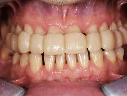 Para la transferencia exacta de la posición óptima de los dientes, se procedió a la toma de impresión digital con y sin férula.