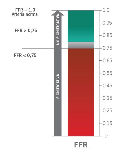 FFR Punto de Corte FFR = 1.0 à Arteria Normal FFR > 0.80 à FFR < 0.