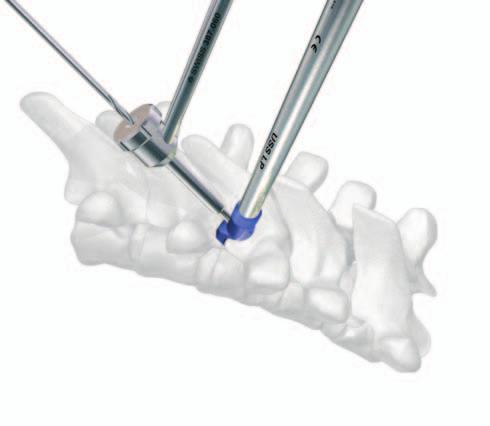 Introduzca la palanca de colocación en el orificio del tornillo del gancho pedicular y coloque el gancho en el pedículo vertebral previamente preparado.