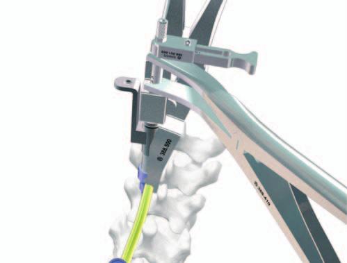 4 Aproximación de la barra hacia la abertura lateral del implante Coloque las pinzas de separación vertebral sobre la barrita de sujeción, entre el clip de tracción y el