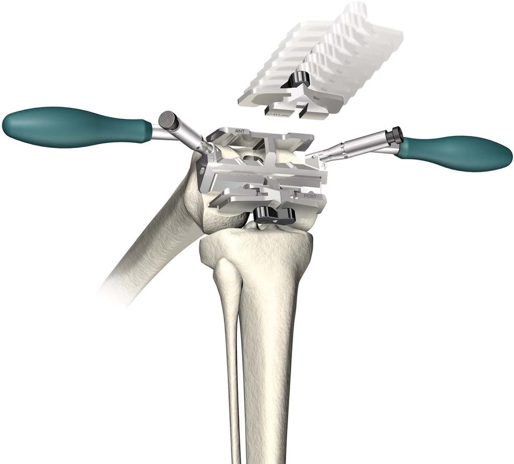 Flexibilidad El sistema de rodilla Triathlon TM ofrece al cirujano plena flexibilidad intraoperatoria con instrumentos diseñados para adaptarse a las realidades quirúrgicas y a una gran variedad de