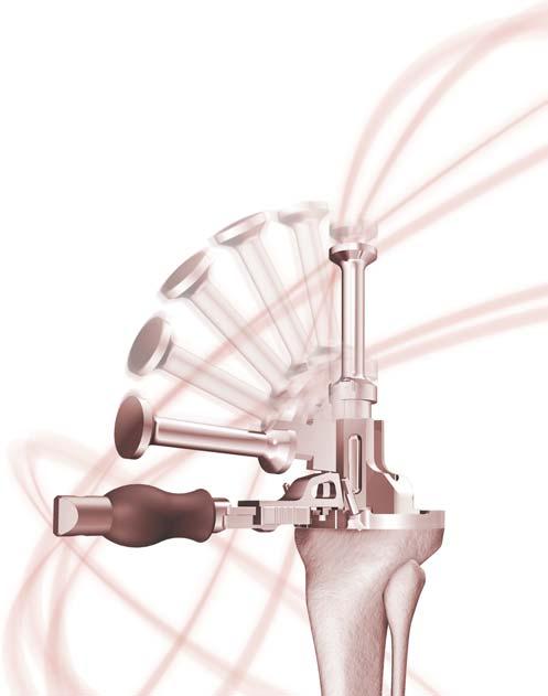 El diseño de los instrumentos se adapta a la geometría del implante, permitiéndoles encajar dentro de la ventana necesaria para la inserción del implante.