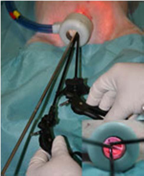 Cirugía transorificial