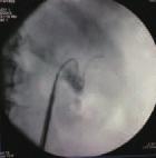 ClearPetra, se debe retirar el endoscopio lentamente hasta cerca de la bifurcación (banda roja) de la vaina ClearPetra.