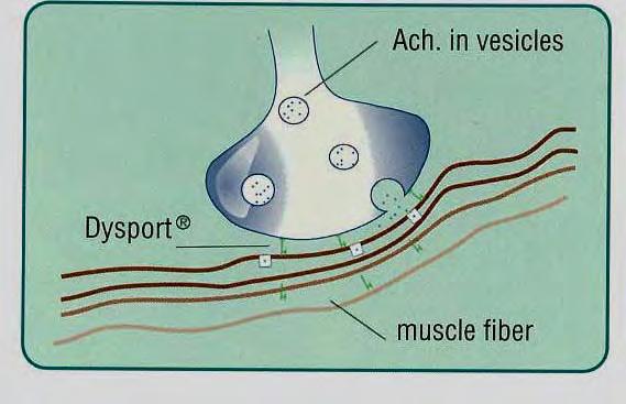 La TXB se inyecta en el vientre muscular y actúa sobre la placa motora y sobre las fibras nerviosas colinérgicas del sistema nervioso