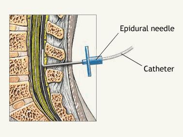 BLOQUEOS CENTRALES Bloqueo epidural Bloqueo intratecal Epidural: