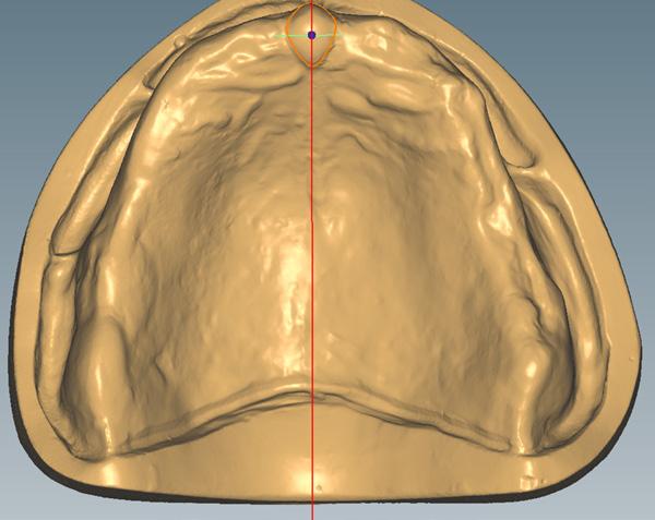 Determinación de la línea periférica labial en el maxilar superior Definir: La línea periférica labial se genera automáticamente a 8 mm del centro de la papila incisal.