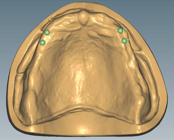 Determinación de la posición de los primeros premolares en el maxilar superior Definir: Las posiciones de los premolares del maxilar superior se definen colocando puntos con el ancho de un premolar