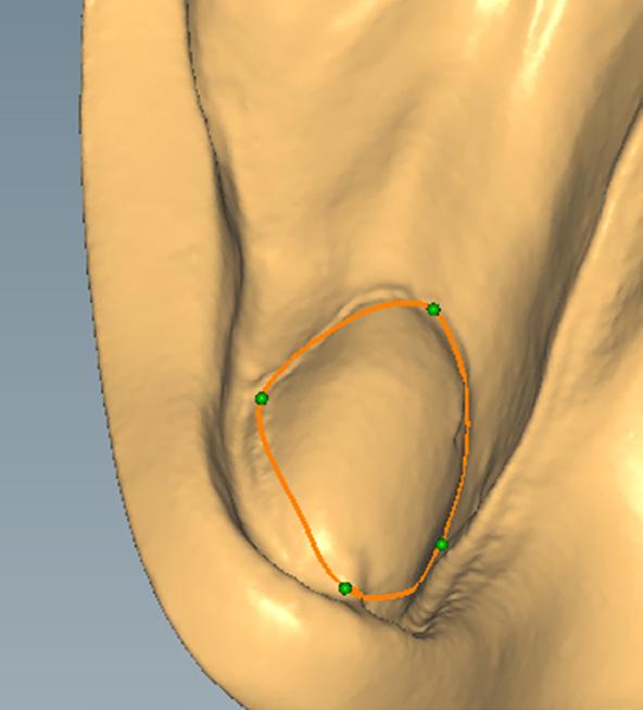 Determinación de la posición de los primeros premolares en el maxilar inferior Definir: Las posiciones de los primeros premolares inferiores se marcan como una extensión de las frénulas, o un poco