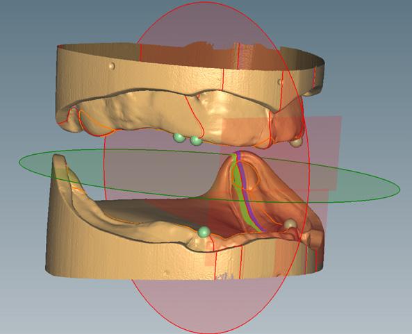 La línea media de la cresta alveolar sirve para transferir la posición del primer molar del maxilar inferior al maxilar superior.