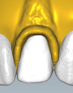 Adaptación de las bases de las prótesis y los dientes al modelo Img.